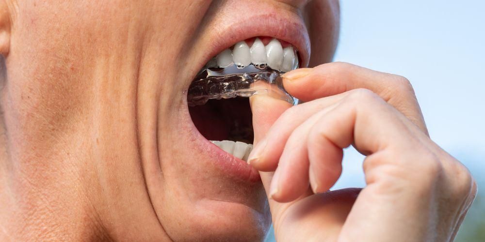 Comment redresser les dents sans appareil dentaire, utiliser des dispositifs de retenue pour aligneurs