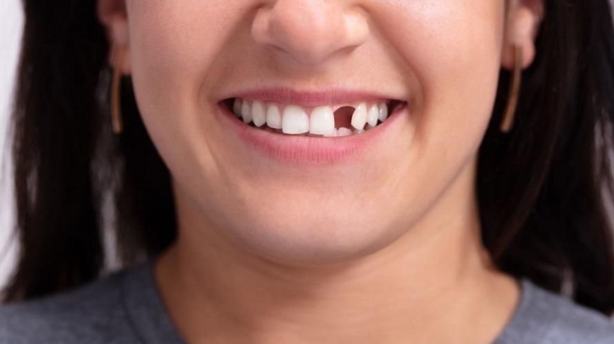 성인이 되어 빠진 치아가 다시 자랄 수 있는 방법이 있나요?