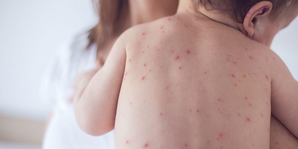 10 types de maladies de la peau chez les enfants qui peuvent survenir
