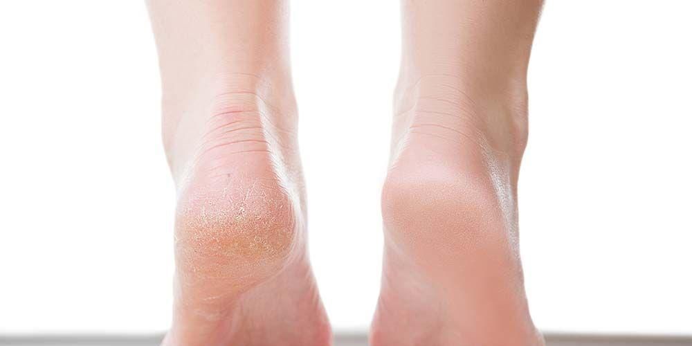 갈라진 발, 사용할 수 있는 천연 성분 없애는 방법