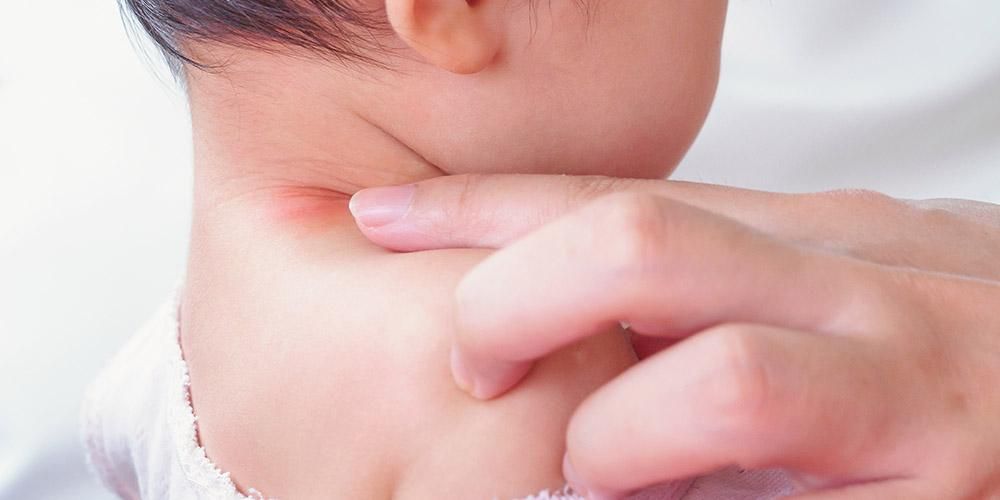 6 Uzroci crvenih mrlja na dječjoj koži bez temperature i njihovo rukovanje