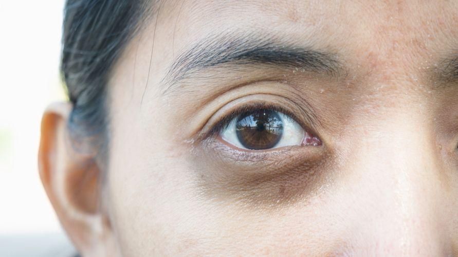 Различные эффекты опоздания на лицо, от морщин до мешков под глазами