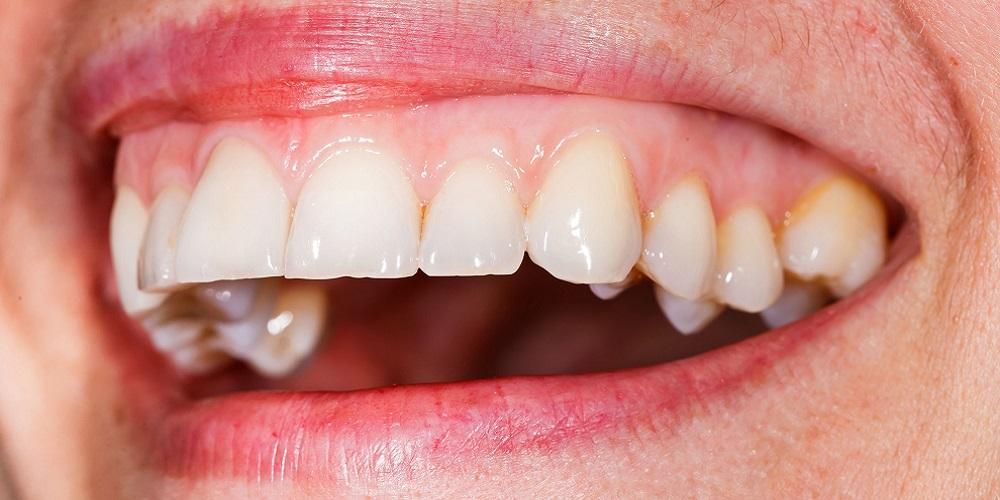 6 formas de enrojecer las encías negras según las recomendaciones del dentista