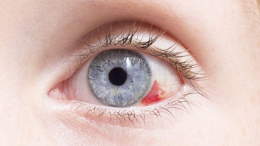 10 orsaker till trasiga ögonblodkärl som måste övervakas