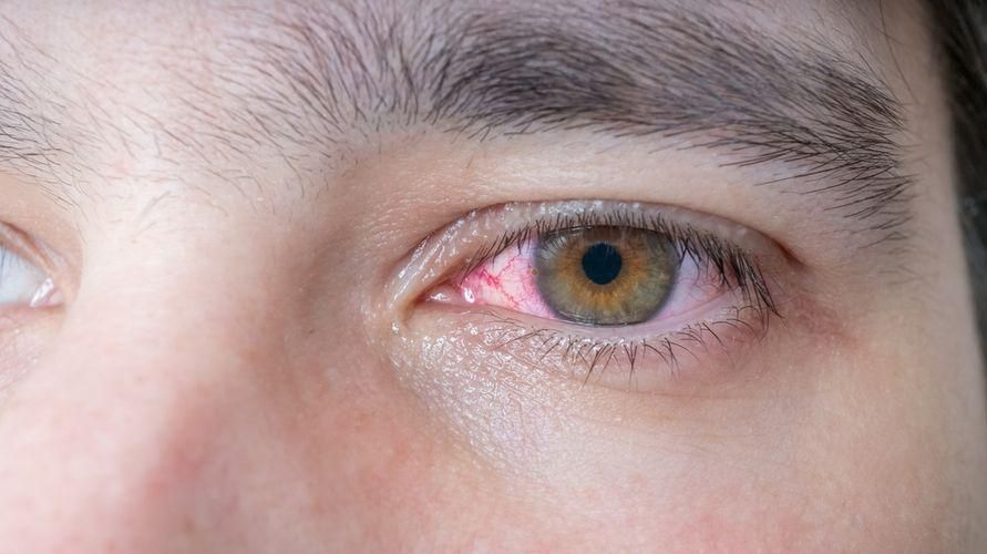 Przyczyny czerwonych żył w oczach i jak je przezwyciężyć