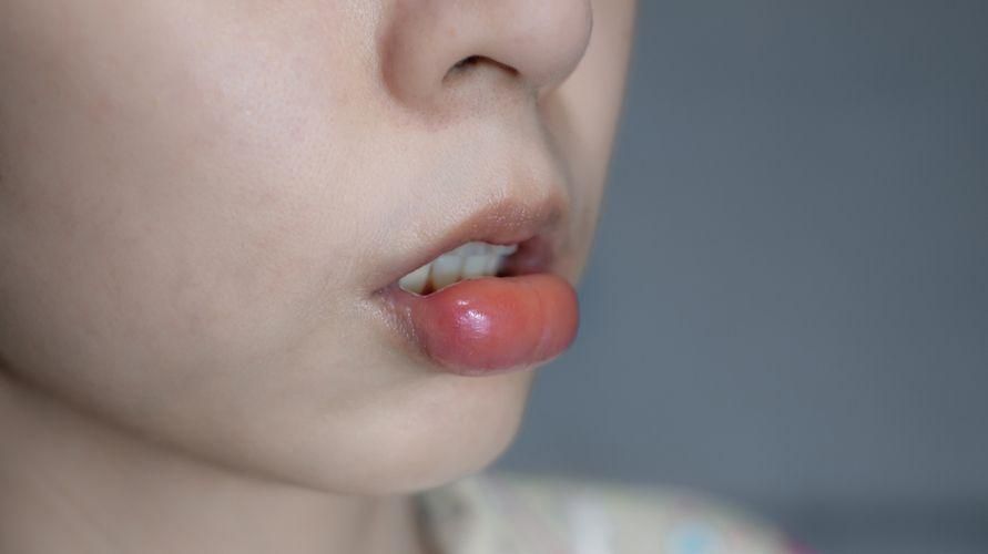 7 cauze ale buzelor umflate după trezire