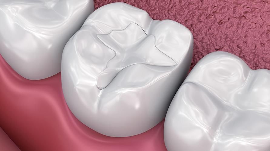 Obturații dentare temporare vs permanente, care este mai bine?