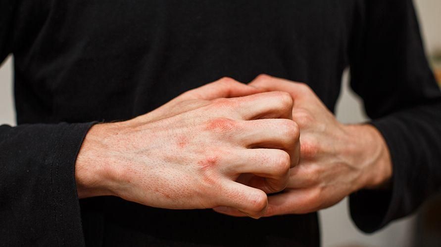 가려운 손가락과 물집: 원인과 치료 방법