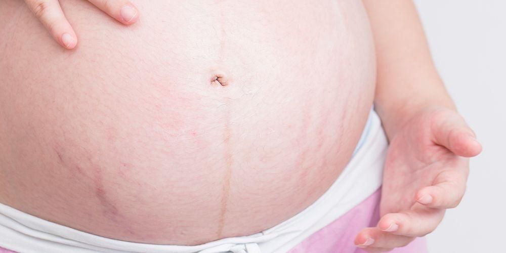 Przyczyny powstawania rozstępów w ciąży i jak je przezwyciężyć