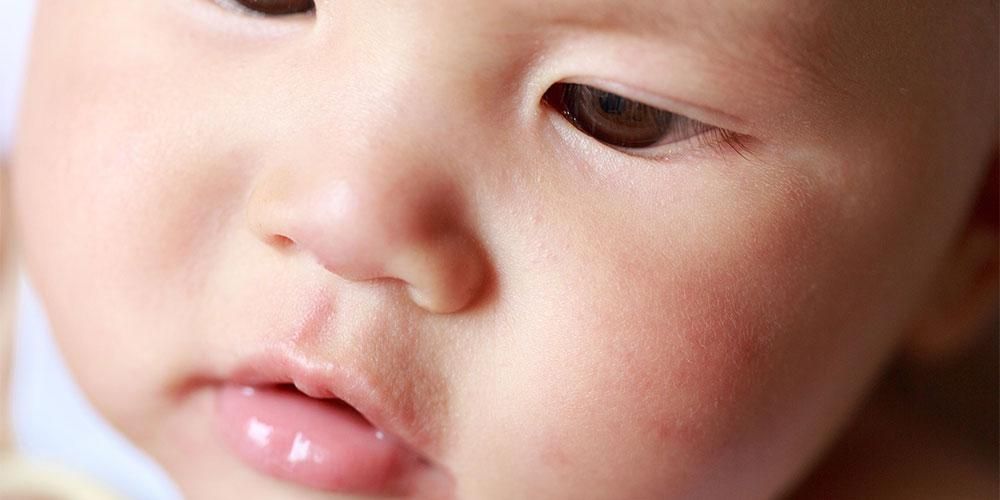 Vita fläckar på barnets ansikte som Panu, symtom på Pityriasis Alba