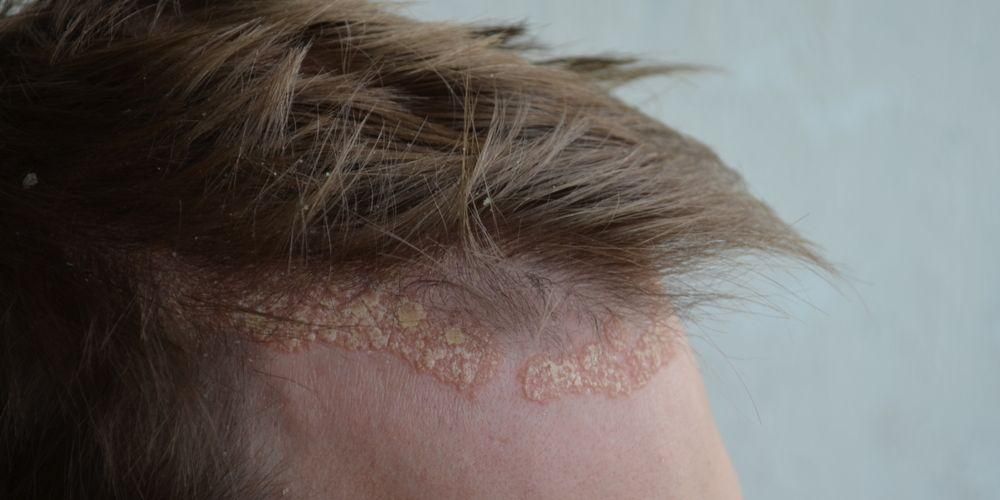 A fejbőr pikkelysömörének okai, tünetei és kezelése