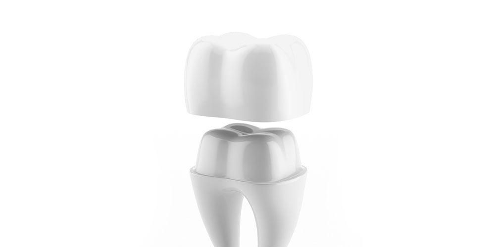Möchten Sie eine Zahnkrone installieren? Verstehen Sie zuerst den Typ und das Installationsverfahren