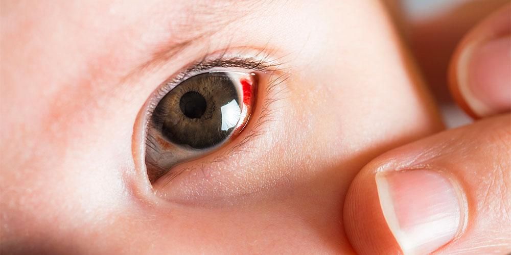 Diverses causes des yeux rouges de bébé et comment les surmonter