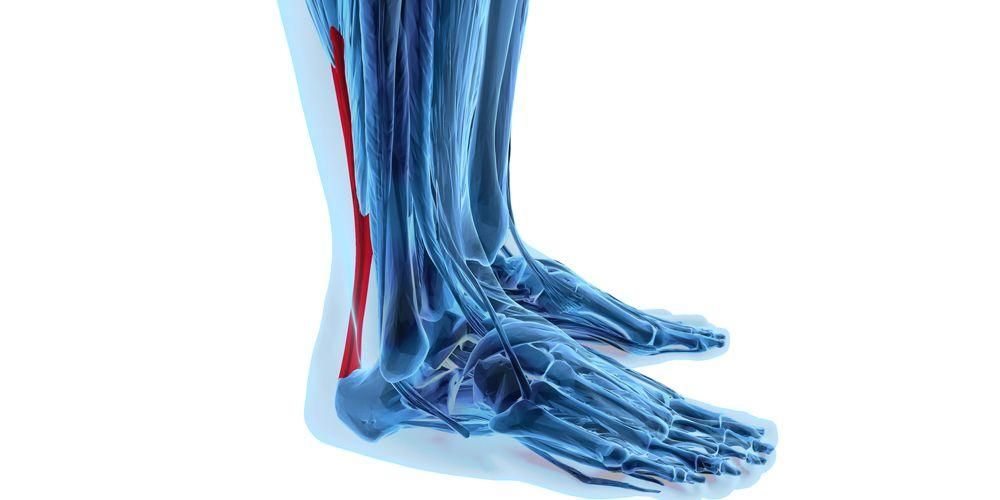 Achilles tendinitis is een ontsteking van de pees, wat veroorzaakt het?