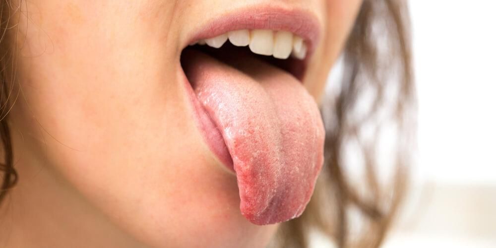 Les changements de couleur de la langue peuvent détecter cette maladie
