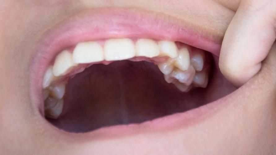 Gestapelte Zähne bei Kindern sollten sofort behandelt werden, hier ist der Grund