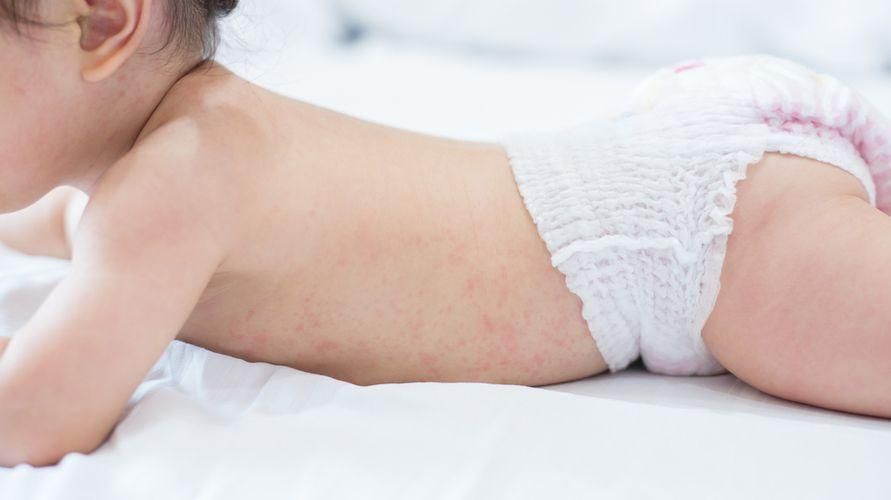 5 przyczyn występowania czerwonych plam po gorączce u dzieci, które należy obserwować