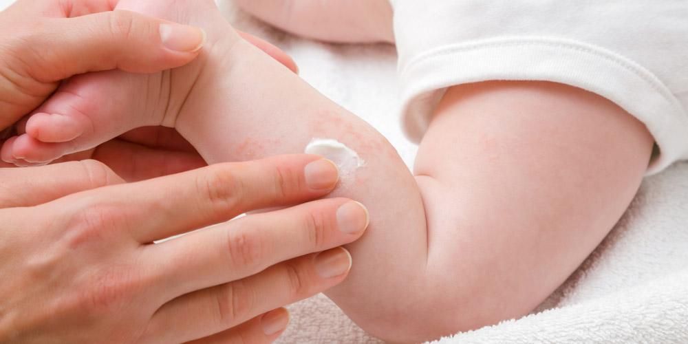 Juckreizsalbe für Babys, was sind die sicheren Empfehlungen?