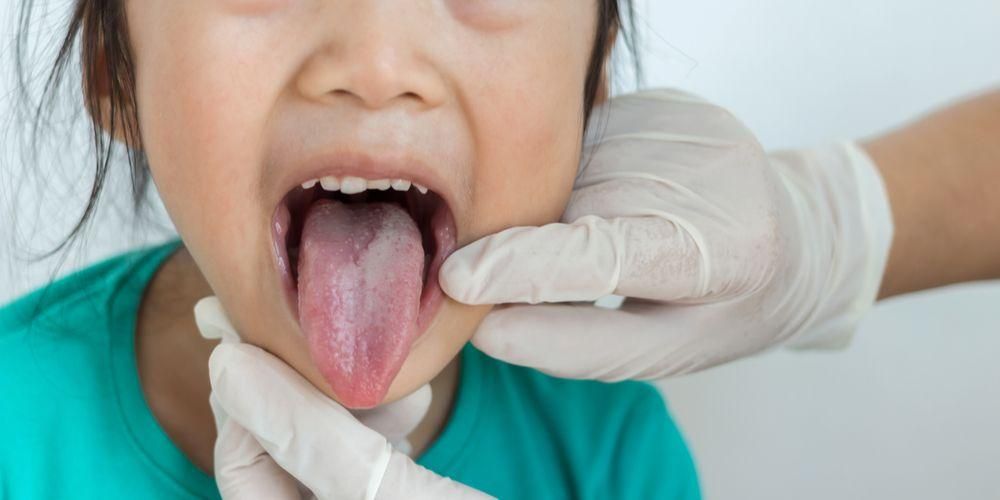 8 Ursachen für Beulen auf der Zunge, auf die Sie achten sollten