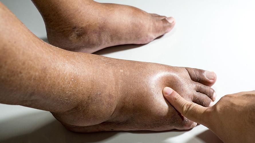 Duzzadt lábak idegrendszeri rendellenességekhez, lehetnek a Beriberi tünetei?