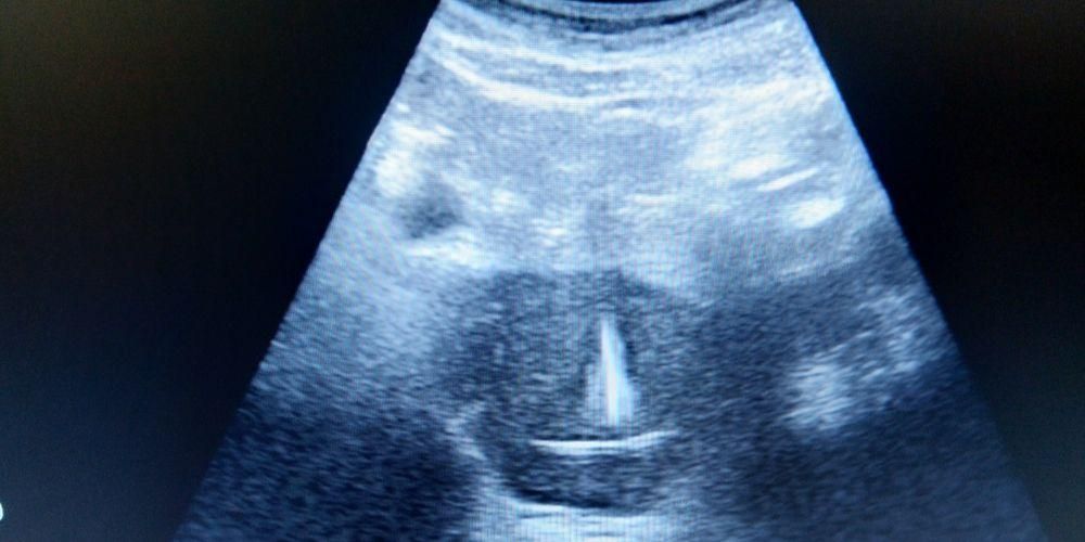 거꾸로 된 자궁은 어떻게 임신 할 수 있습니까?