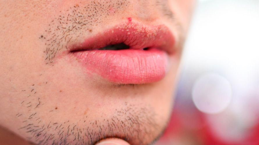 Przyczyny białych plam na ustach i jak się ich pozbyć