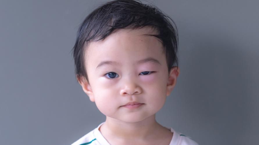 7 причин опухших глаз у детей и эффективные решения