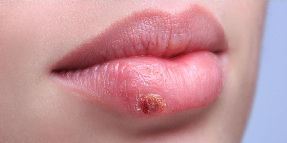 Plaies rouges autour de la bouche, serait-ce l'herpès labial ?
