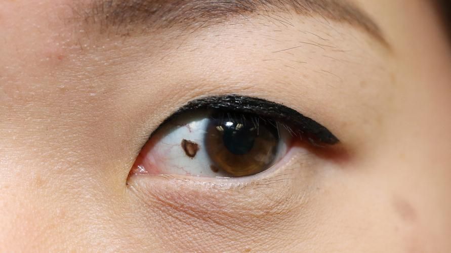 Будьте начеку, темные пятна в глазах могут указывать на серьезное состояние, это причина