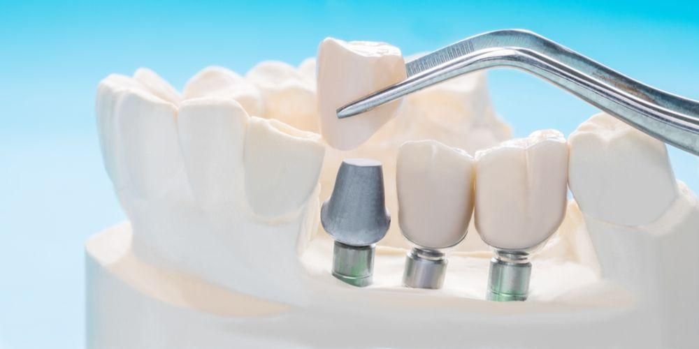 Хотите зубные имплантаты? Сначала ознакомьтесь с процессом установки