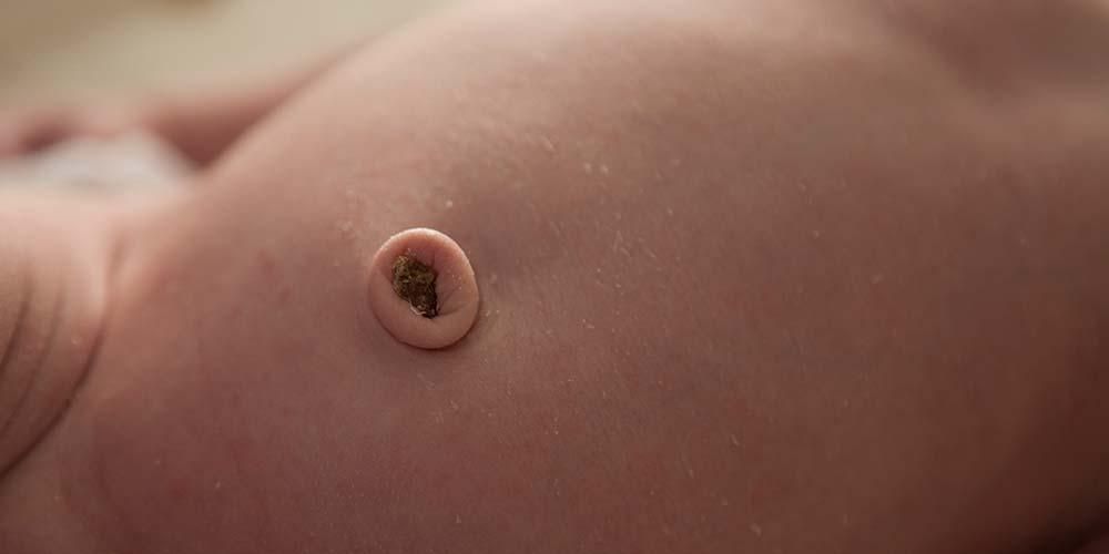 Umbilikalni granulom, malo meso koje se često pojavljuje nakon odumiranja bebinog pupka