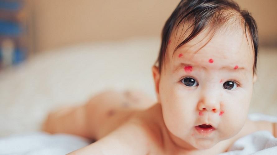 Golpes de agua en la piel del bebé, estas son las causas y cómo tratarlas