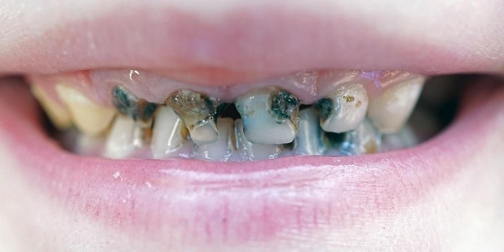 Zahnwurm verursacht Zahnschmerzen und Karies, Mythos oder Tatsache?