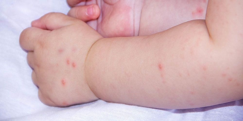 가정에서 어린이의 싱가포르 독감을 극복하는 방법
