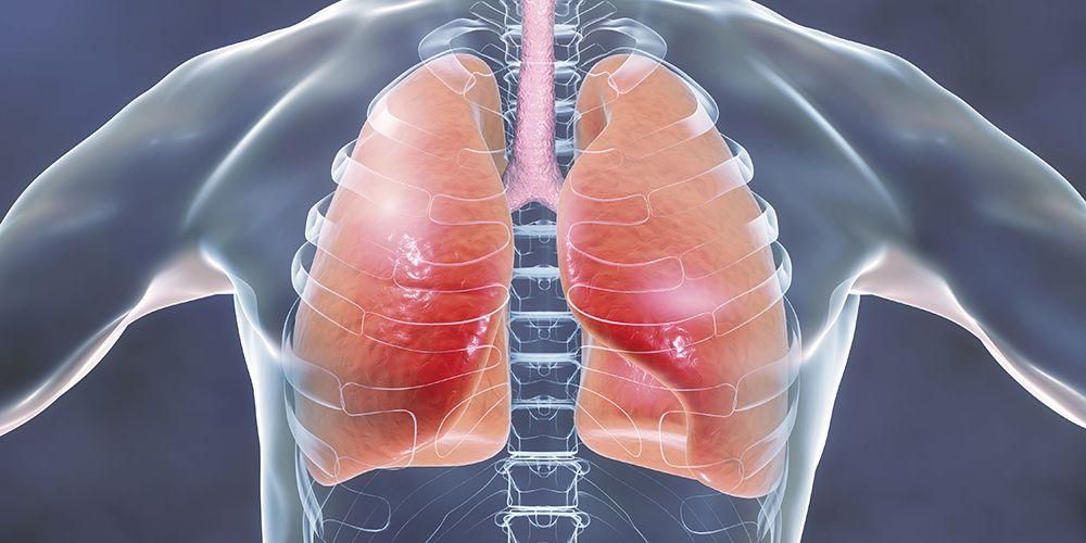 ¿La bronquitis es contagiosa? Depende del tipo de bronquitis.