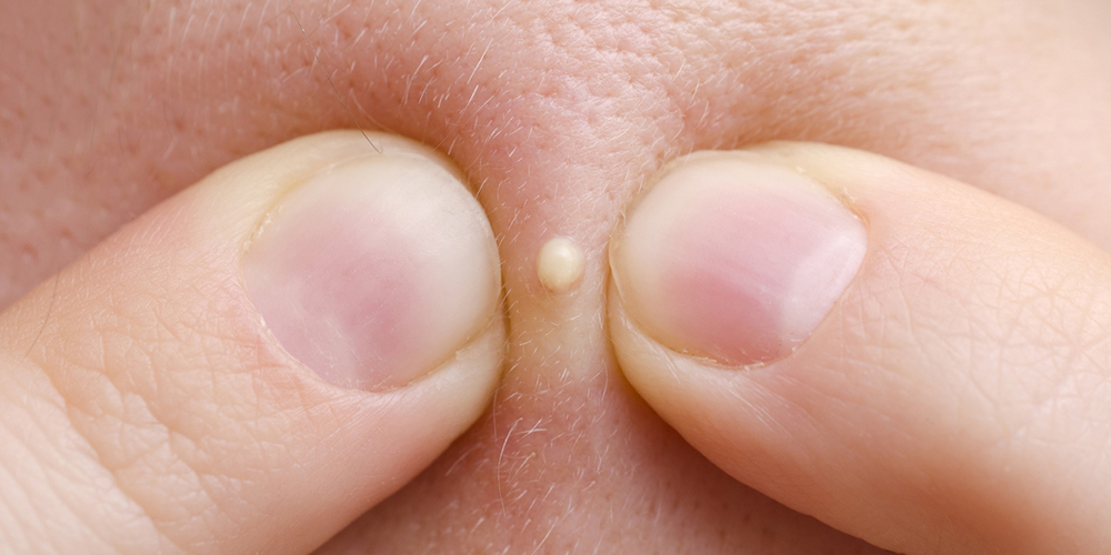 Cunoașteți tipurile de acnee și cum să depășiți dreptul