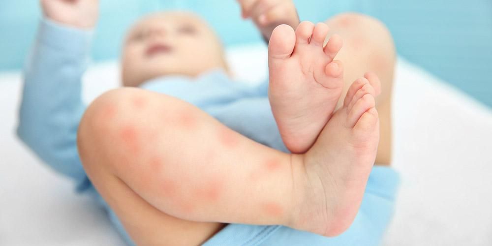 Види шкірної алергії у немовлят, які причини і як її запобігти?