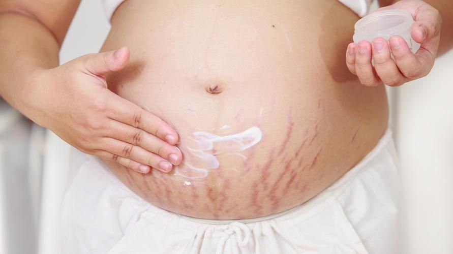 9 דרכים להיפטר מסימני מתיחה במהלך ההריון, הכירו גם את המניעה
