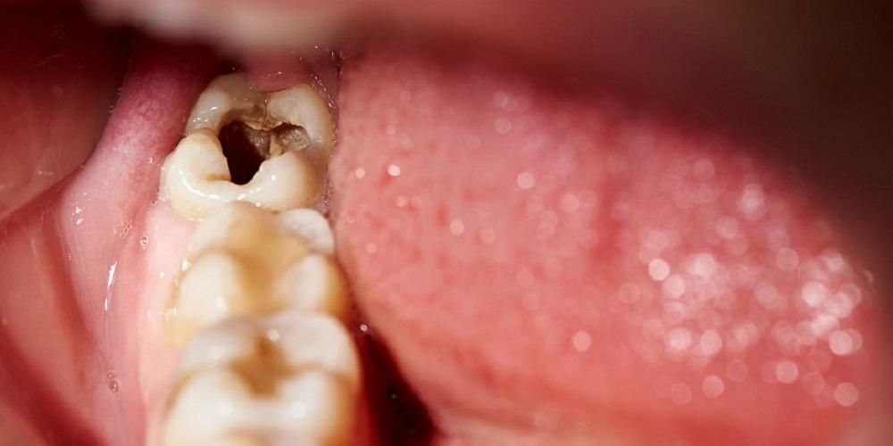 Nécrose pulpaire, maladie lorsque les caries dentaires sont grandes mais non douloureuses