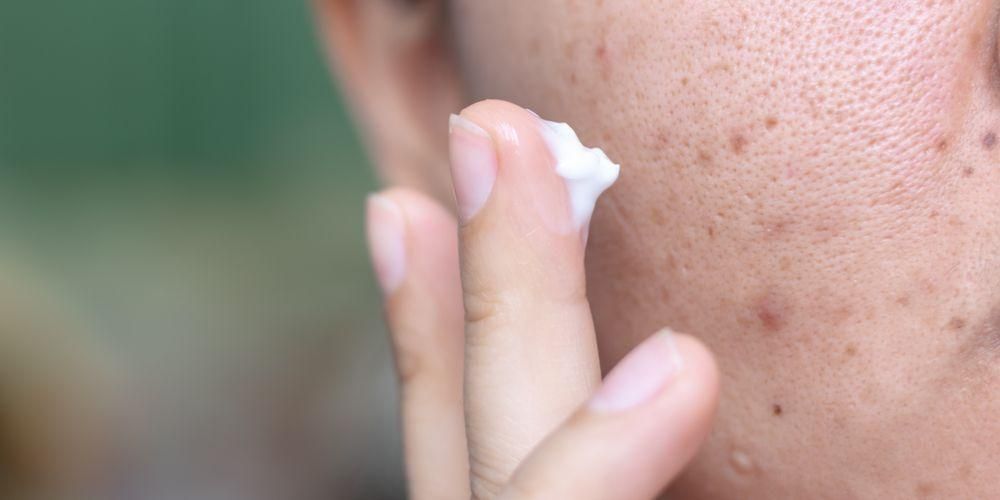 Hur man blir av med irriterande cystisk akne säkert och effektivt