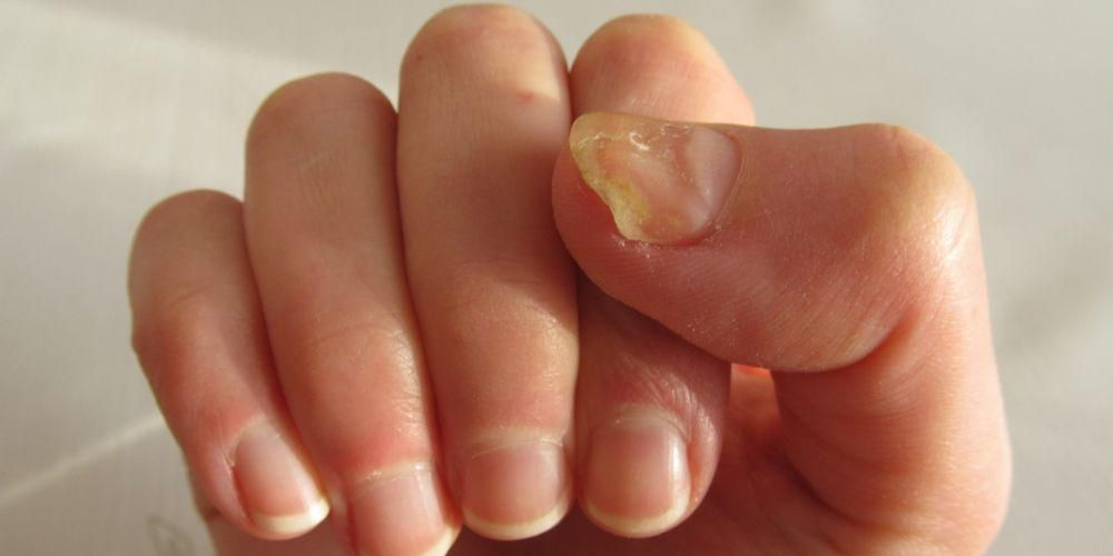 Узнайте о различных причинах появления желтых ногтей.