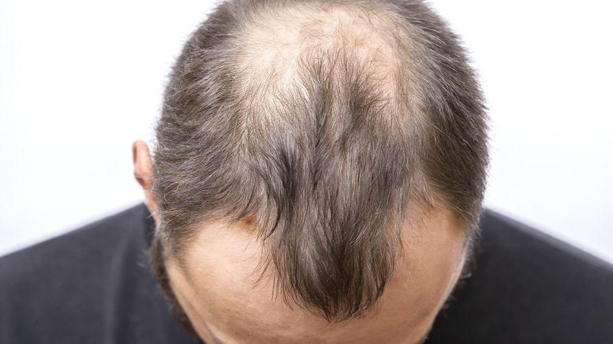 Az alopecia kopaszodást okoz a hajban, visszanőhet?