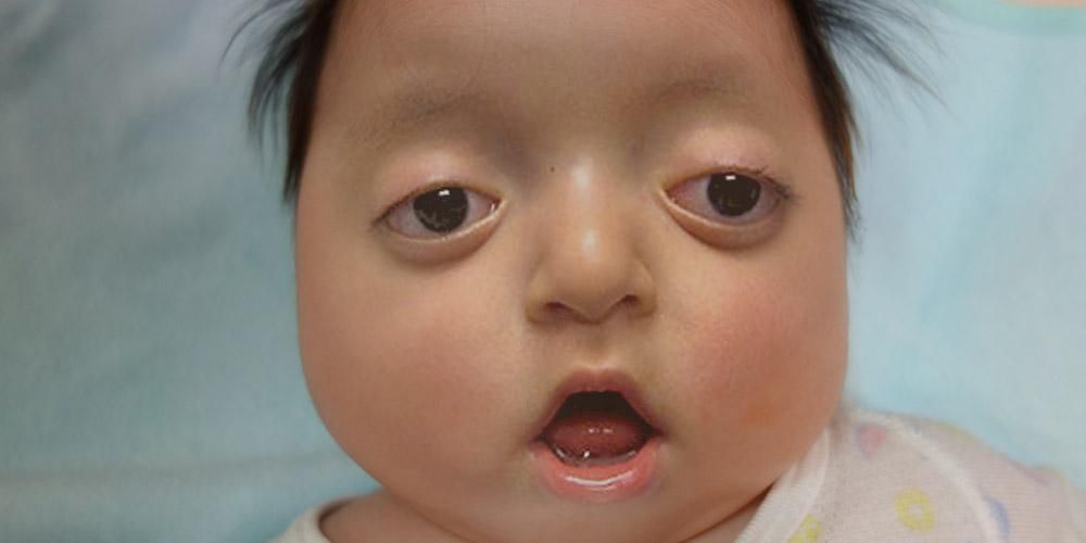 Lernen Sie das Pfeiffer-Syndrom kennen, eine Erkrankung, die bei Babys Gesichtsanomalien verursacht