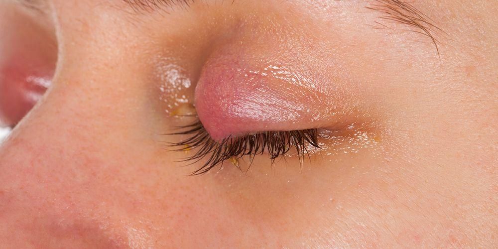 눈꺼풀 염증의 원인과 치료 방법