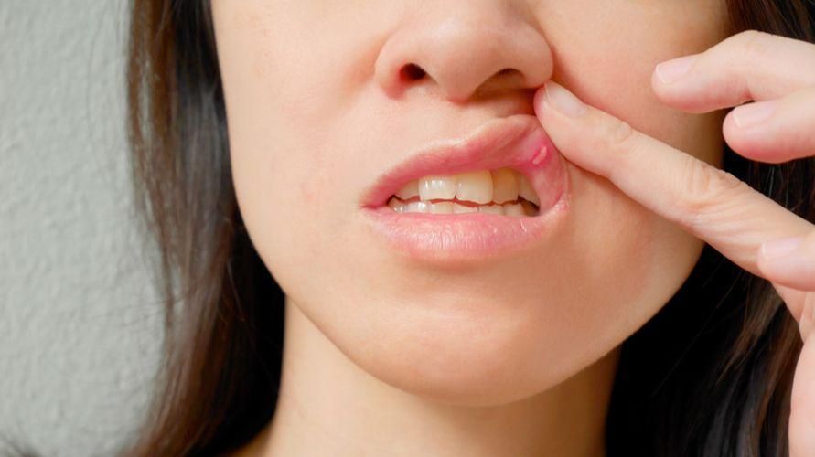 Arten von Mund- und Zahnerkrankungen, auf die Sie achten müssen