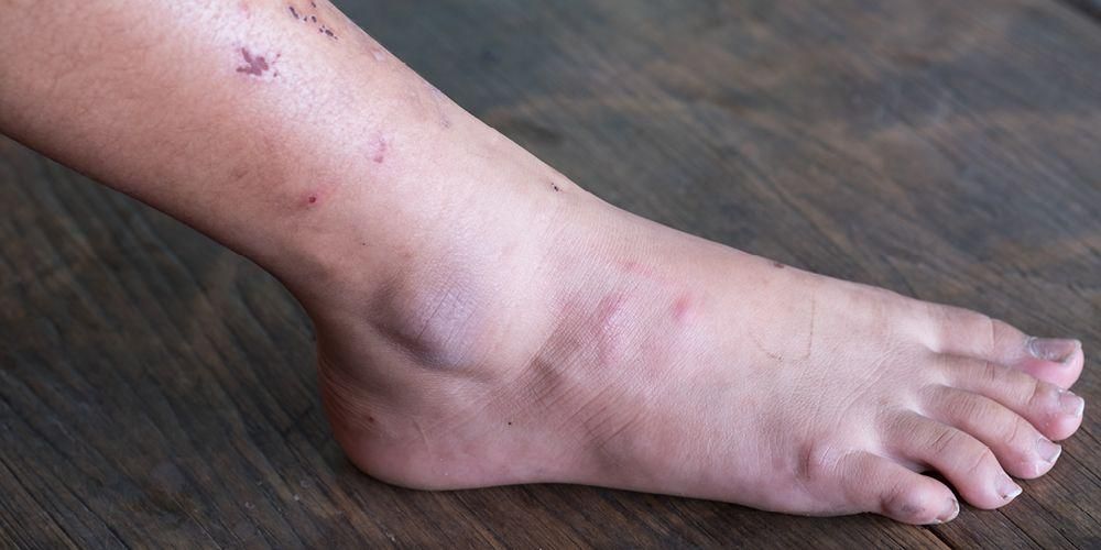 Upoznajte karakteristike dijabetičkih rana na stopalima i kako ih spriječiti