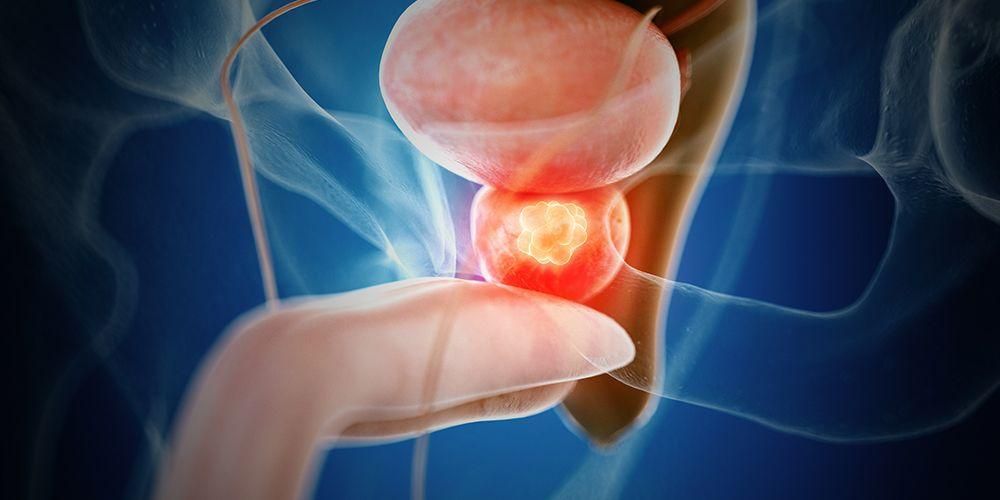 Connaître les types, les risques et les complications de la chirurgie de la prostate