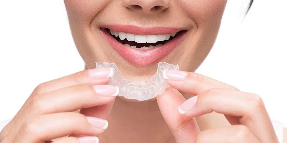 Les appareils dentaires ne sont pas les seuls, il existe encore 6 façons d'inverser les dents tordues