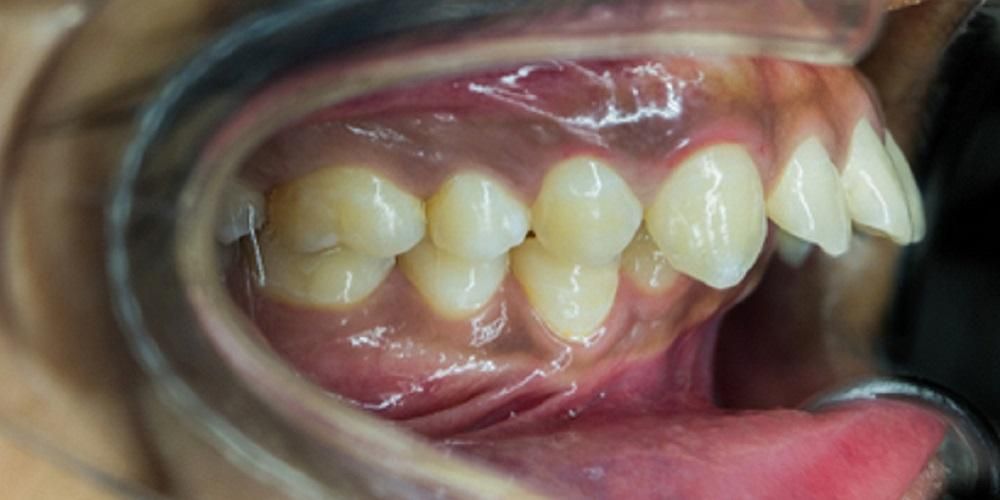 Ursachen für schiefe Zähne und wie man sie wieder ausrichtet.