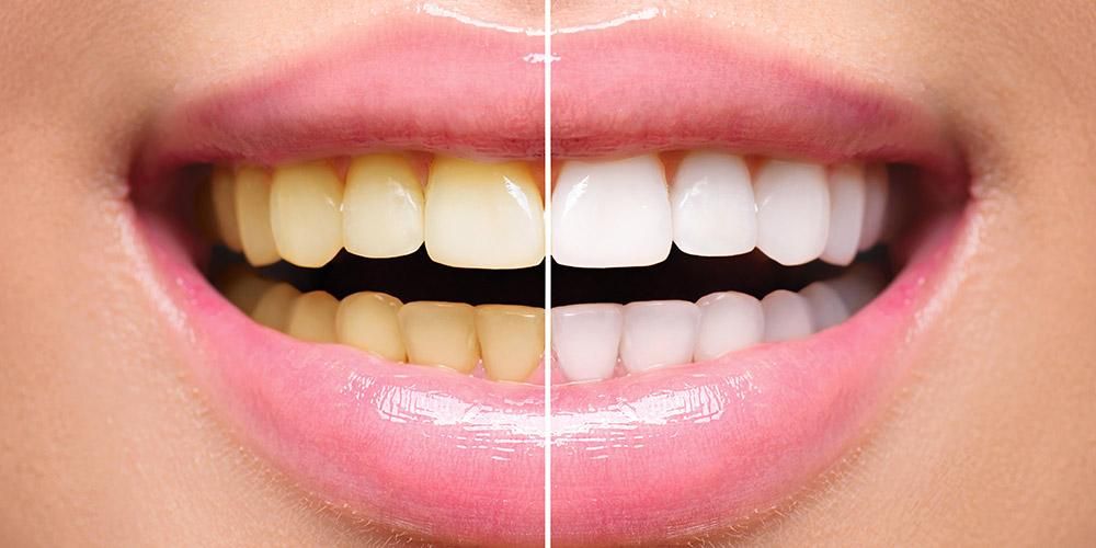 Jednostavni načini izbjeljivanja žutih zuba kod kuće
